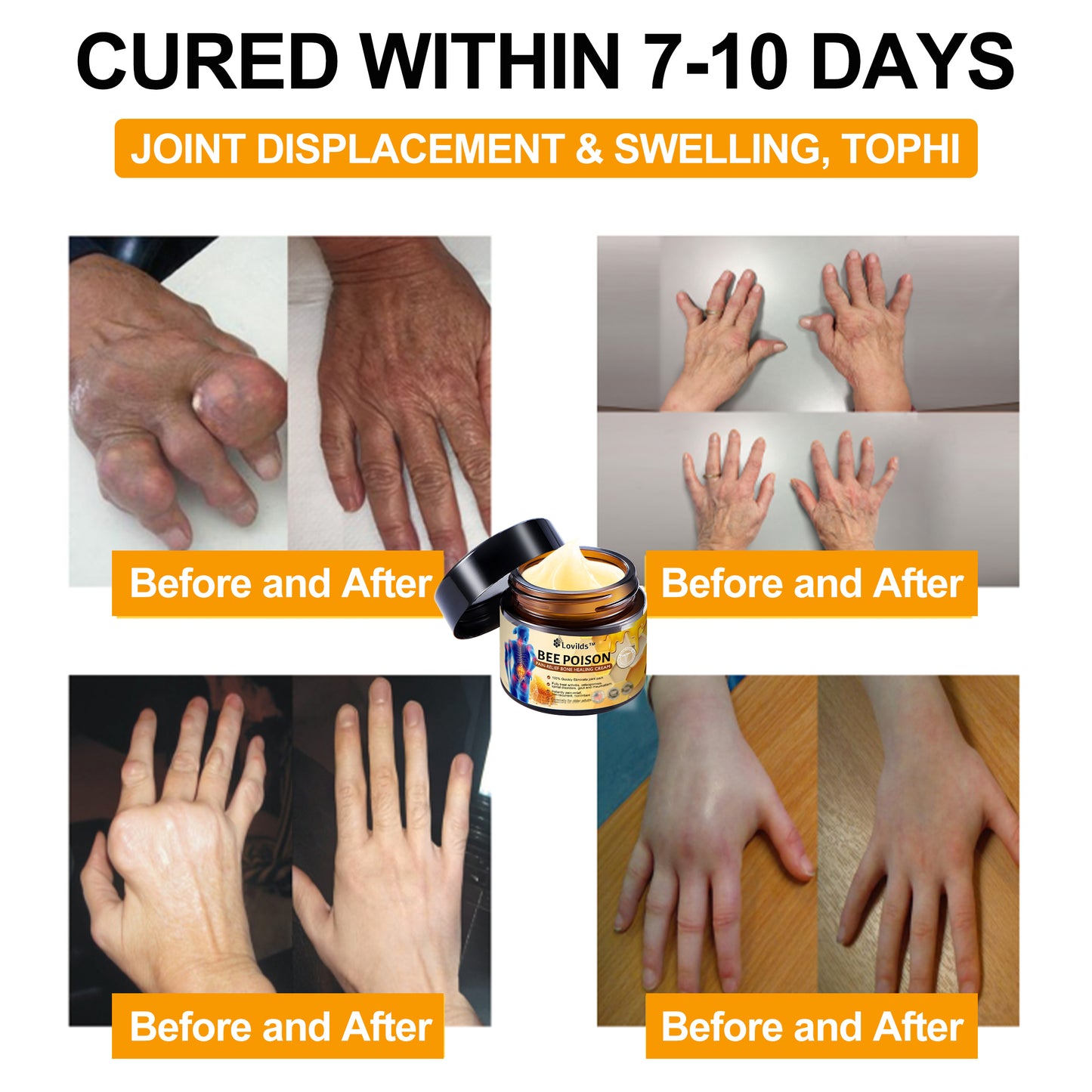 Lovilds™ Bee Poison Arthritis Therapy Cream(Specially for older adults & AAOS recommends)