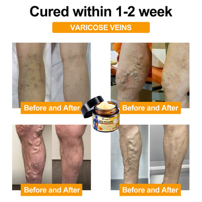Lovilds™ Bee Poison Arthritis Therapy Cream(Specially for older adults & AAOS recommends)